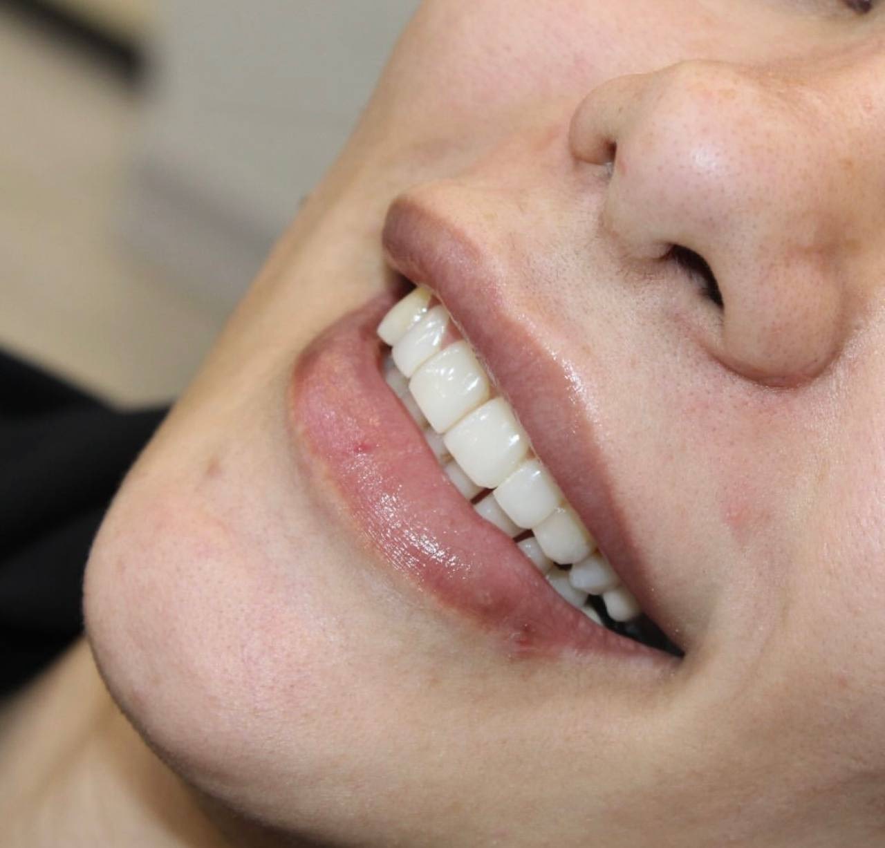 بلیچینگ دندان